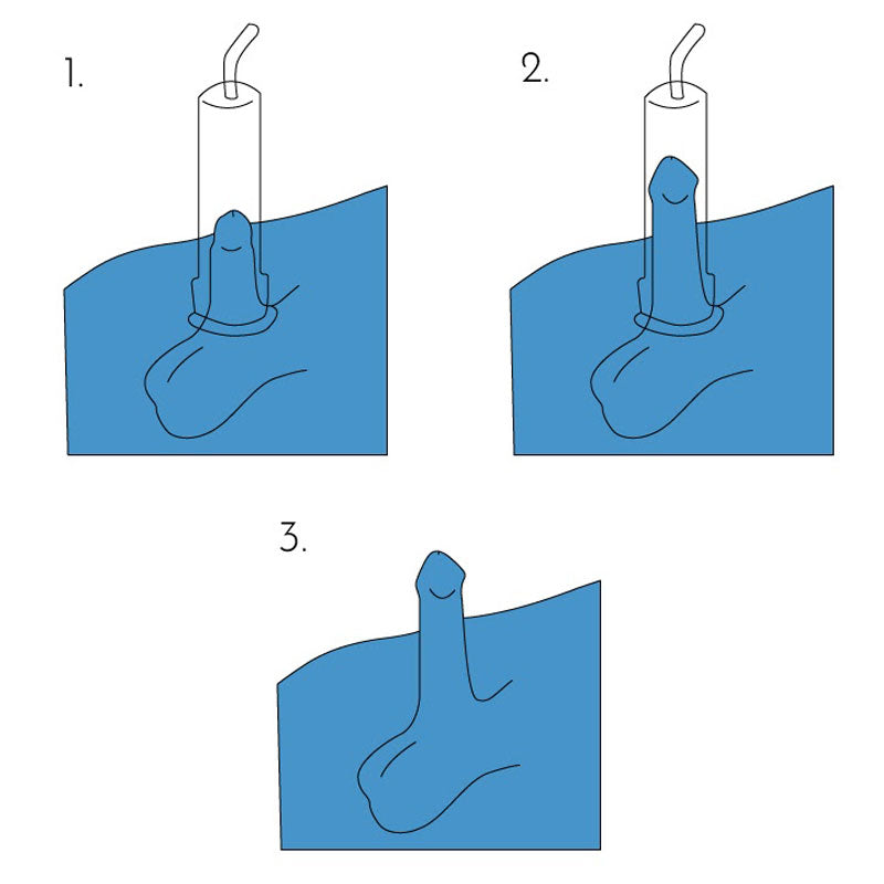Diagram of how penis pumps work