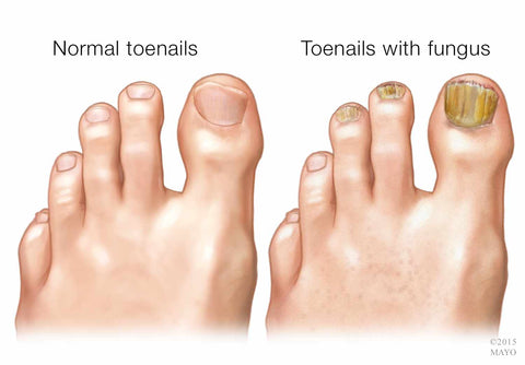 Mayo Clinic Foot Fungus Diagram Image