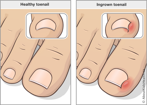 Ingrown Toenail Split Diagram