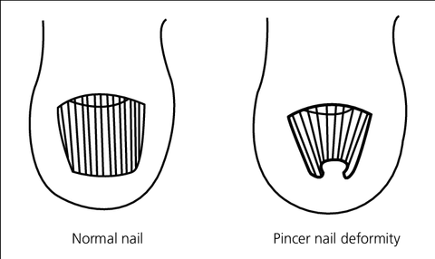 Diagrama de la uña del pie en pinza
