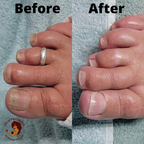 before and after pedicure with toenail fungus