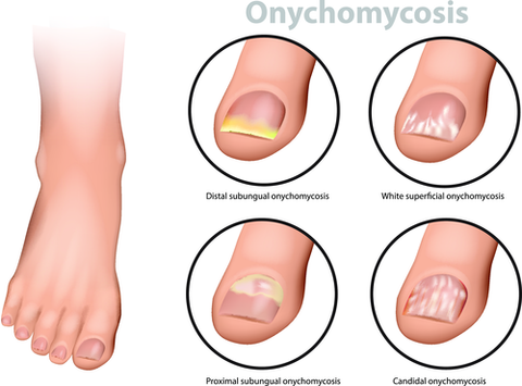 common fungal infections of the toenail