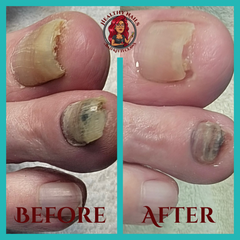 impacted nails advanced pedicure
