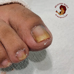 Yellow Toenail Fungus Advanced Pedicure