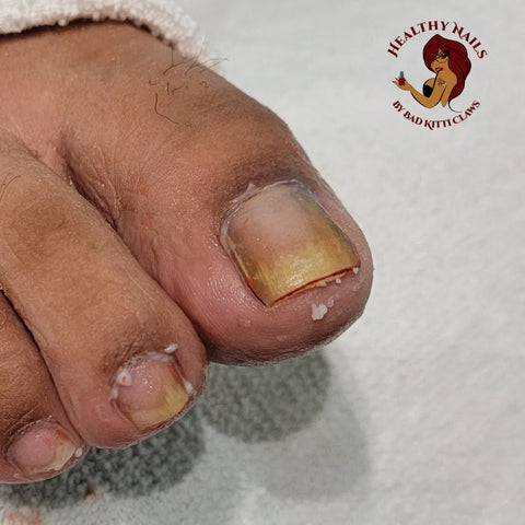 Nail diseases chart: Pictures, symptoms, and treatments