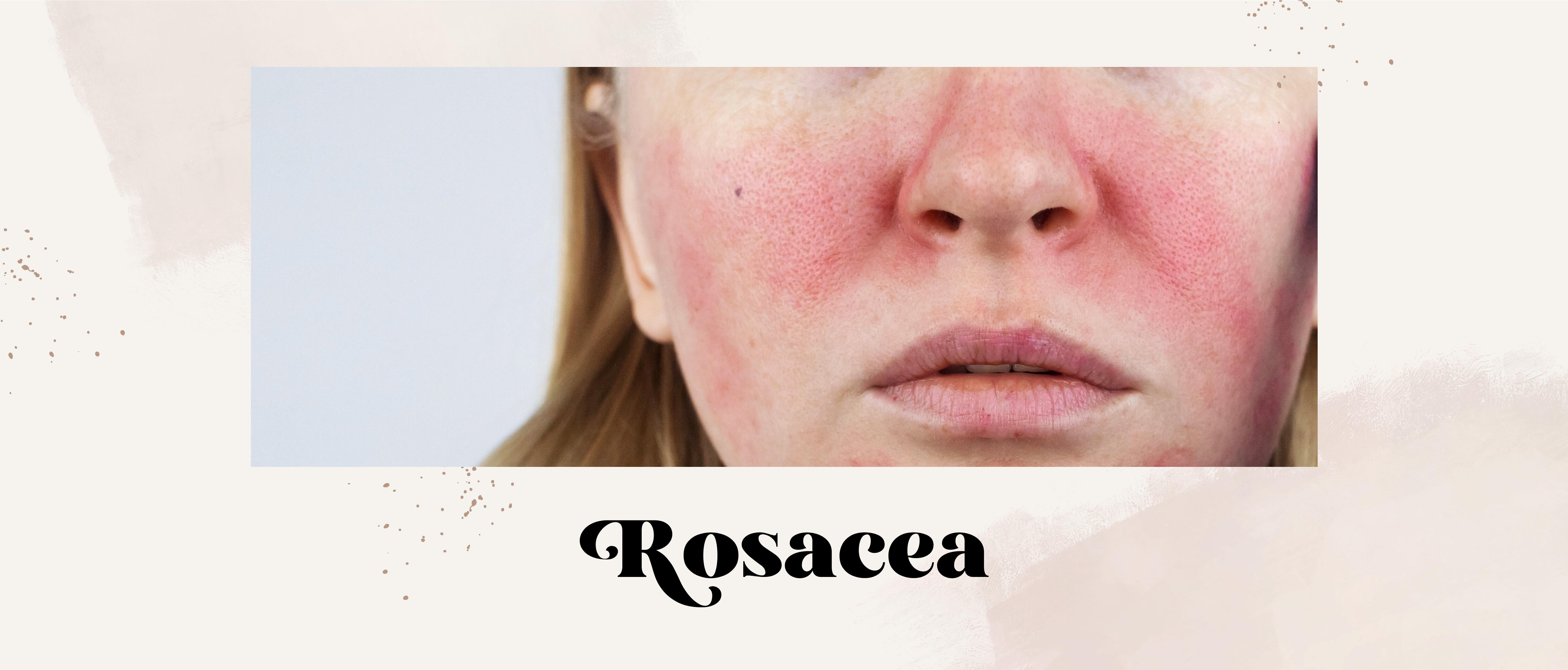 Rosacea Awareness Month Blog