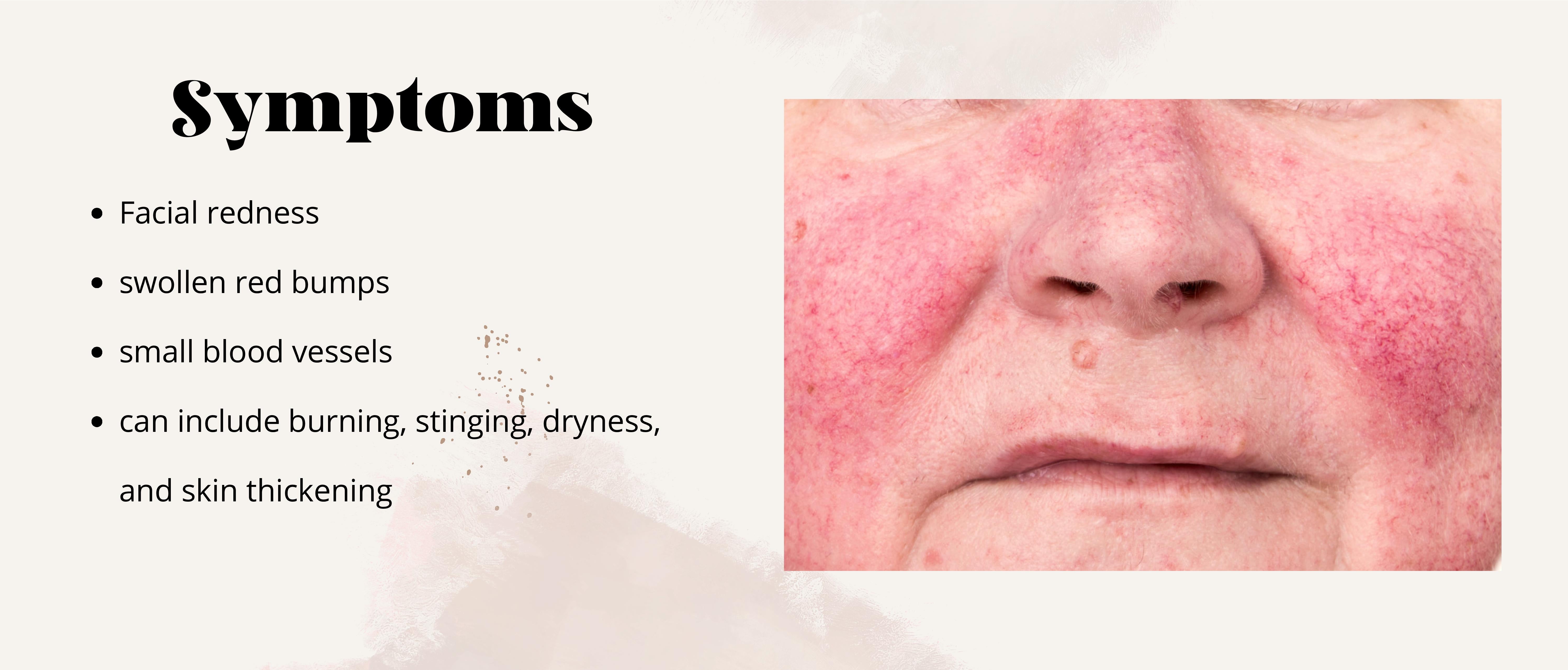 Rosacea Symptoms