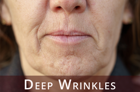 Wrinkles image