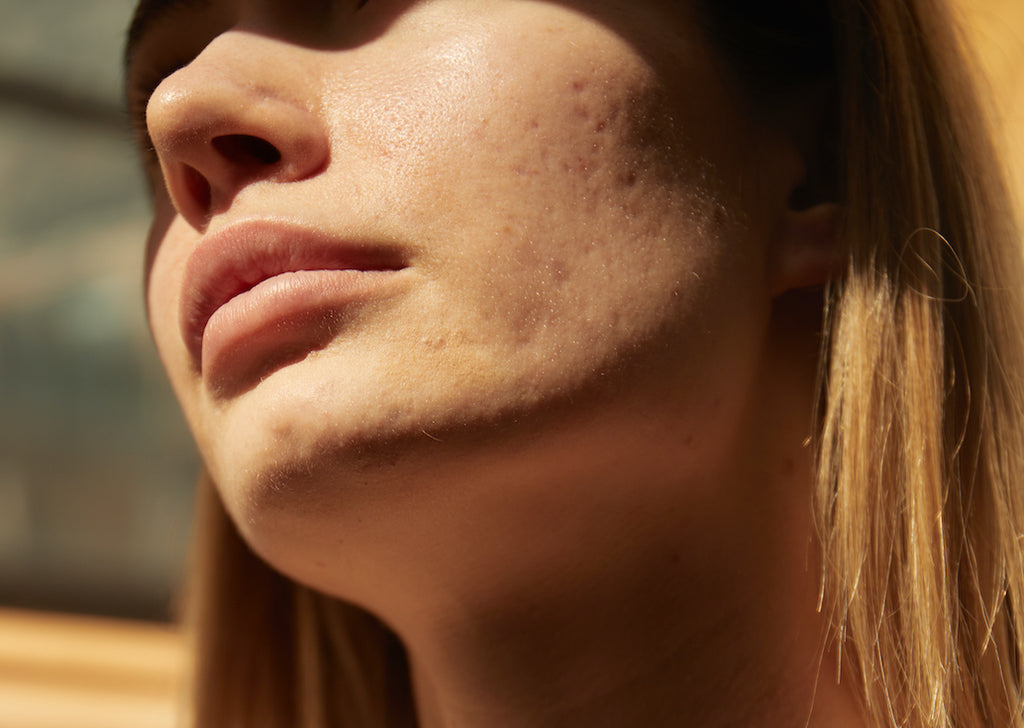 fade pigmentation and acne marks