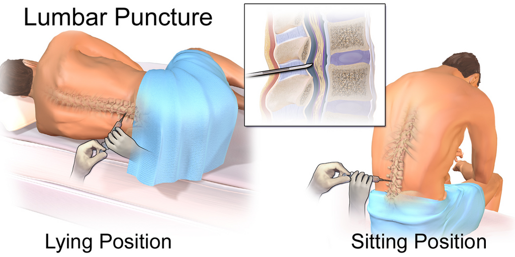 lumbar puncture side effects