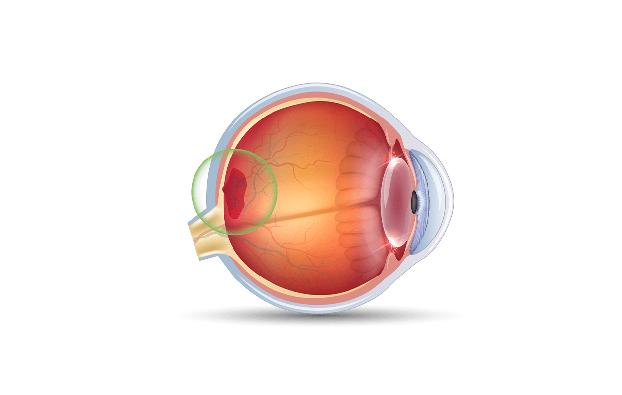 Image of eye showing macular degeneration