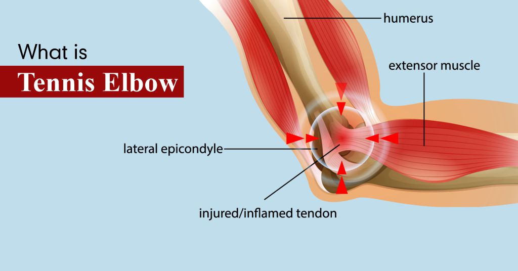 Tennis Elbow