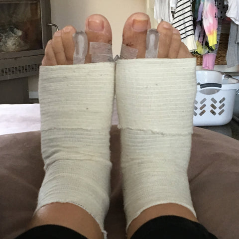 Bunion Surgery Recovery - The Printable Place