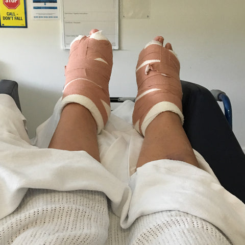 Broken Feet - Bunion Surgery - The Printable Place
