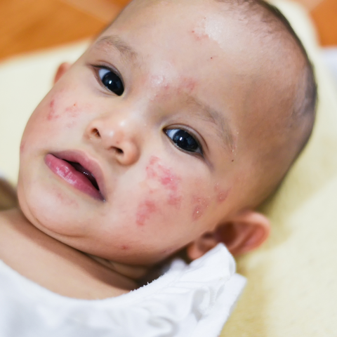 Allergic reaction - hives, skin rash