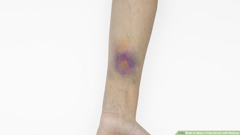 Photo of bruised arm