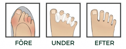 hur din fot förändras med tåseparerare