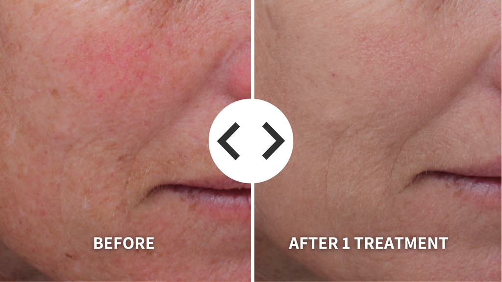 Side-by-side comparison before, and after one treatment.
