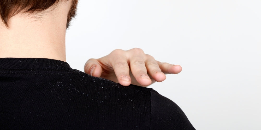 what is the best way to get rid of dandruff?
