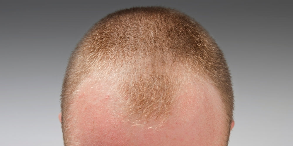 svejsning bestøver friktion How To Thicken Men's Hair Naturally (Thinning Hair in Men) | VITAMAN USA