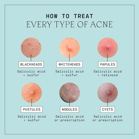 Types of Acne Guide for South Africans – ZONE® DERMASURE®