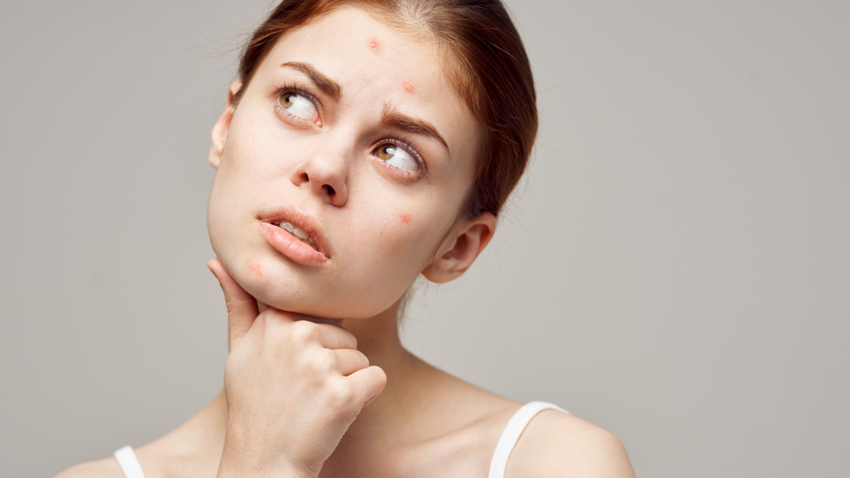 FAQs: About Acne-Prone Skincare - Peaches&Creme K-Beauty and Skincare Shop