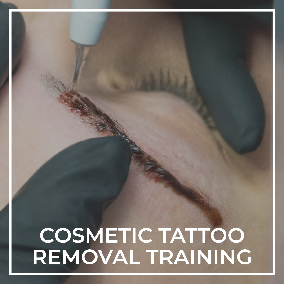 Laser Tattoo Removal Training Certifications  New Look Laser College