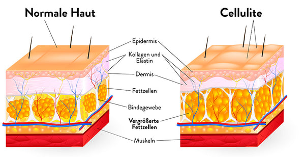 Querschnitt von normaler Haut gegenüber Haut mit Cellulite