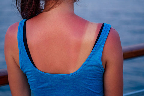 Слънчево изгаряне по кожата на гърба