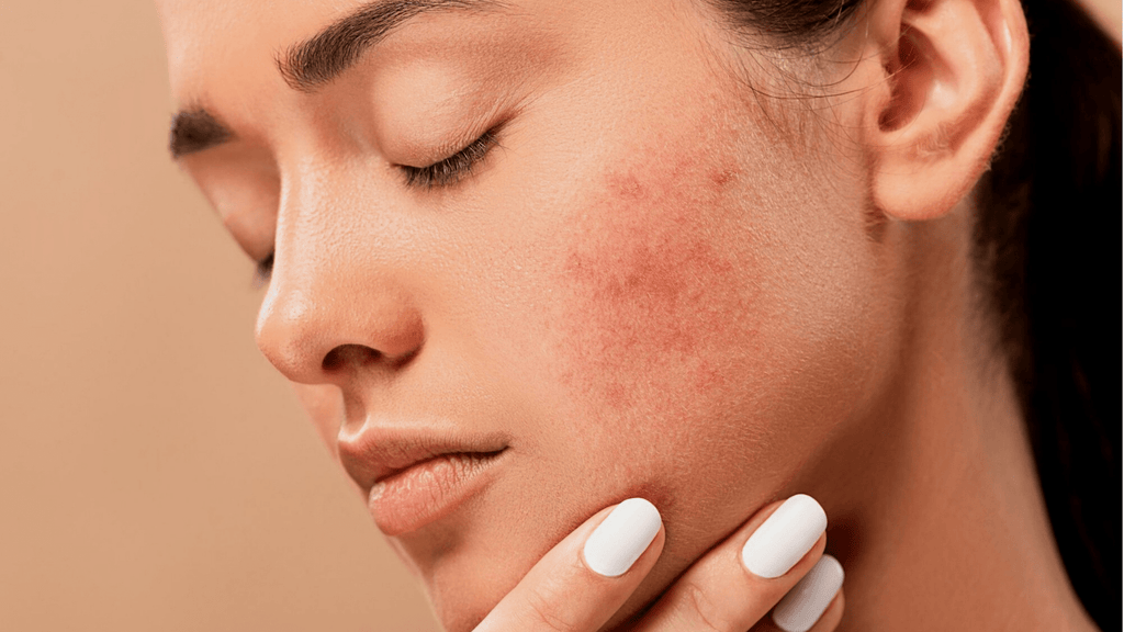 Can Probiotics Actually Treat Acne