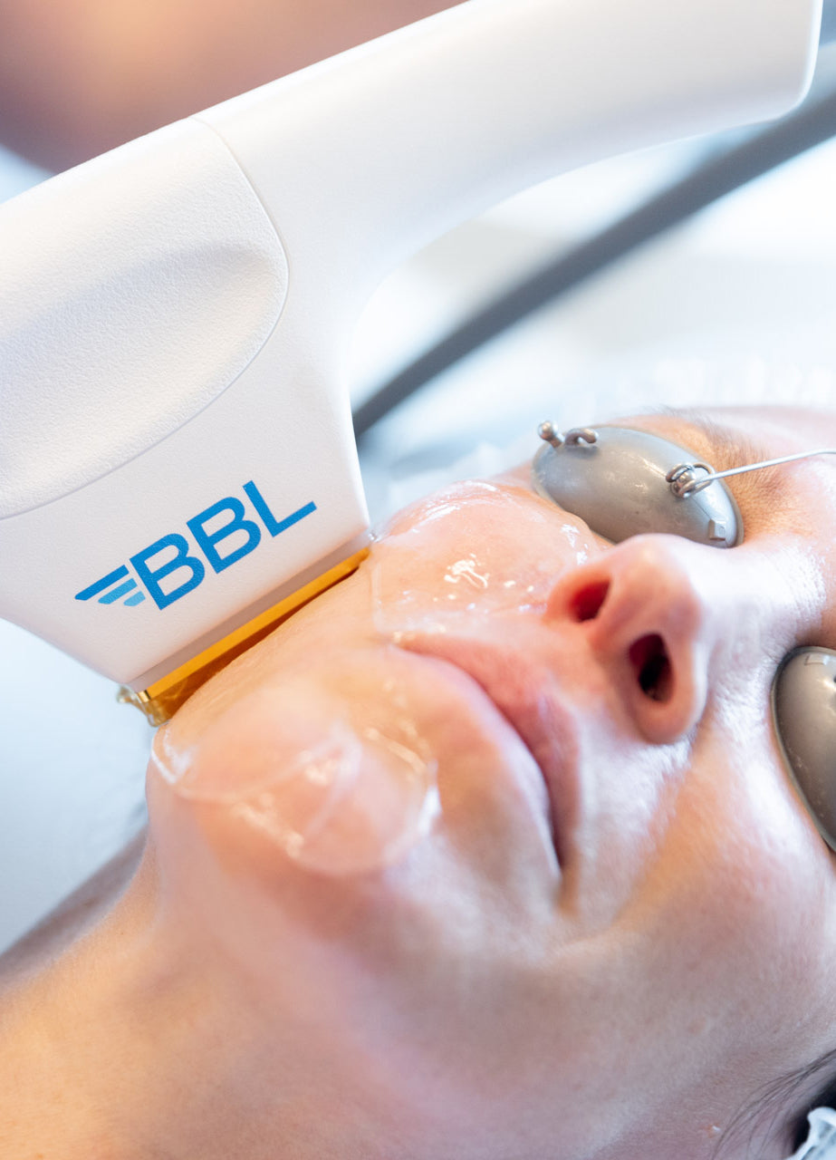 IPL Treatment (BBL® HERO™) in Bellingham, Burlington & Bothell