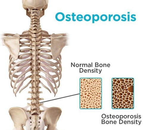Oesteoporosis