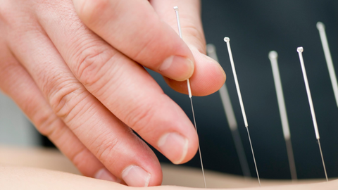 what is acupuncture