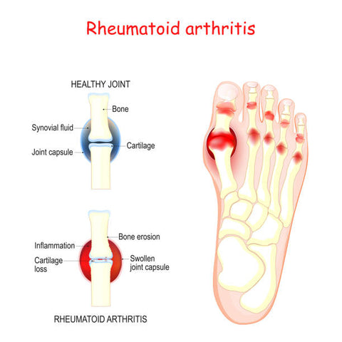 Artritis reumatoide