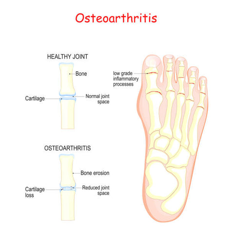 Osteoartritis