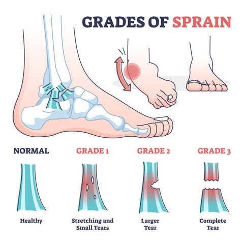 Grades of Ankle Sprain