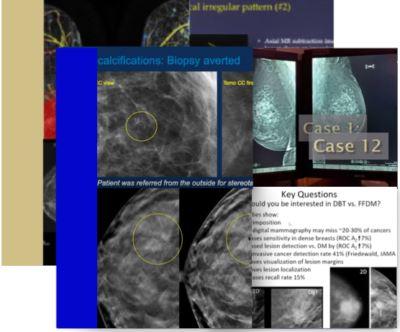 Combine Topics: Breast Tomosynthesis & Breast Imaging CME: Hot Topics - Efficiency Learning Systems