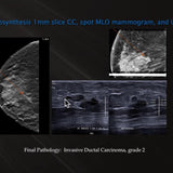 Picture of Case Reviews: Finding Breast Cancer with 3D Breast Tomosynthesis