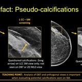 Picture of 2-D Mammography Synthesized from Tomosynthesis: Strengths, Pitfalls, Artifacts