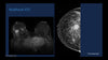 Picture of Breast MRI: Full, Abbreviated, and Ultrafast