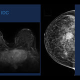 Picture of Breast MRI: Full, Abbreviated, and Ultrafast
