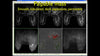 Picture of Breast MRI: Quick and Easy