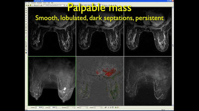 Breast MRI: Quick and Easy