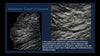 Picture of Calcifications on Digital Breast Tomosynthesis: Challenges and Advantages of Implementing Synthesized View