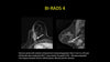 Picture of High Risk Surveillance – Mammographic and MRI Surveillance after Breast Cancer
