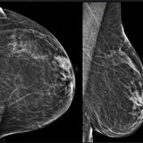 Picture of Tomosynthesis (3D) Breast Biopsy
