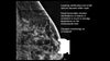Picture of Everything you Wanted to Know About Calcifications