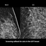 Picture of Cracking the Case: Challenging Calcifications