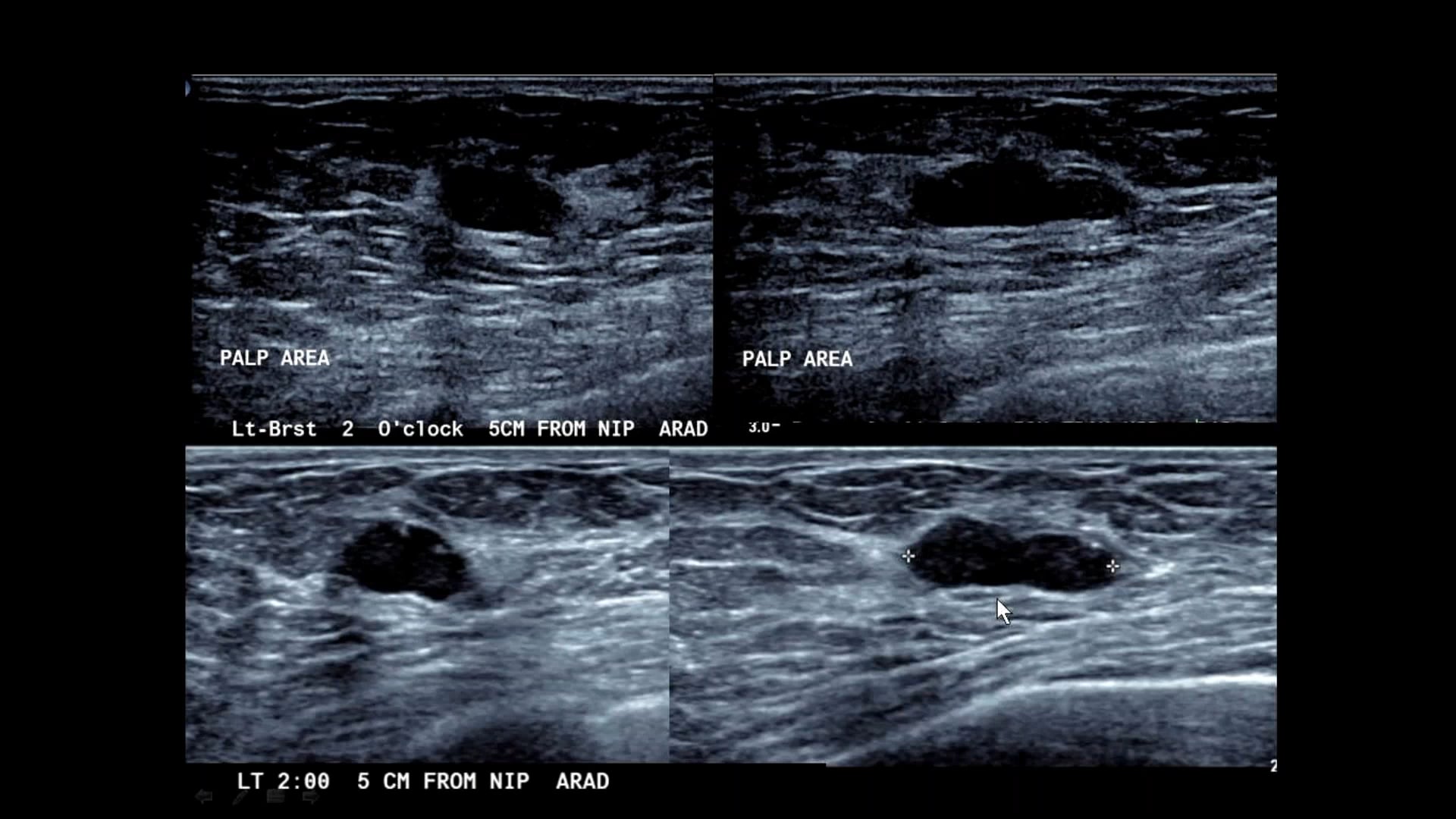 Breast　with　Ultrasound　Dr.　Gundry　ELS