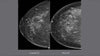 Picture of Breast Tomosynthesis: Comprehensive Breast Imaging Cases